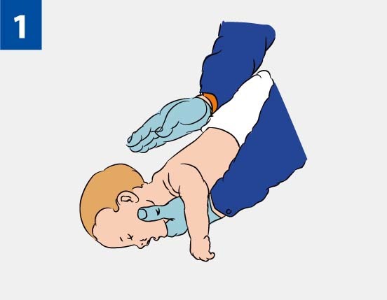 Чужорідне тіло в дихальних шляхах у дитини і у дорослого: перша допомога при асфіксії