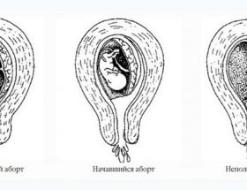 Загроза викидня: стадії розвитку, характерні симптоми, принципи лікування, збереження вагітності