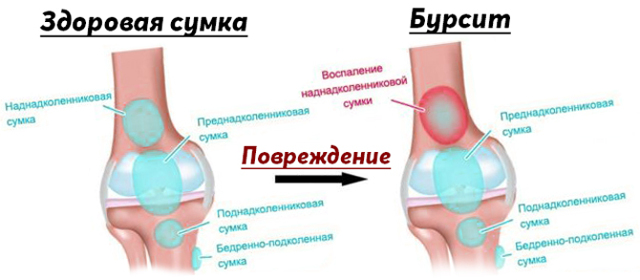 Супрапателлярний бурсит колінного суглоба: що це таке, симптоми і лікування
