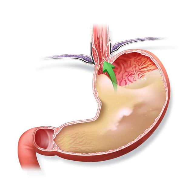 Підвищена кислотність шлунка: симптоми і лікування, дієта, народні засоби