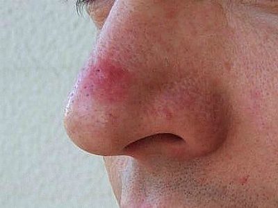 Гемангіома носа у дорослих і дітей: симптоми і лікування