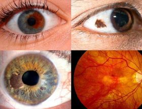 Біла точка, пляма на райдужці ока: причини появи, методи обстеження та особливості лікування