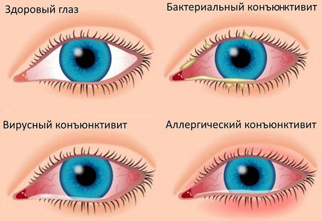 Що робити, якщо опух очей і болить, лікування в домашніх умовах