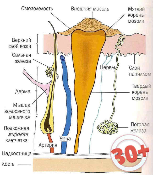 Мозолі на ногах: лікування сухих мозолів, мозолів зі стрижнем, мокрих мозолів, ефективні засоби від мозолів