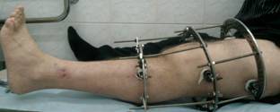 Парапротезних інфекція тазостегнового, колінного суглоба: симптоми, лікування