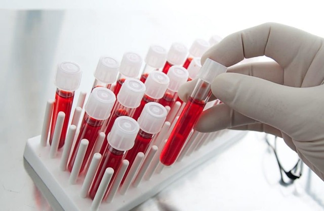 Аналіз крові на ПСА: норма, розшифровка аналізу крові на ПСА, загальний ПСА в аналізі крові