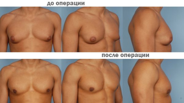 Ліпомастія у чоловіків: як позбутися, фото, лікування, операція