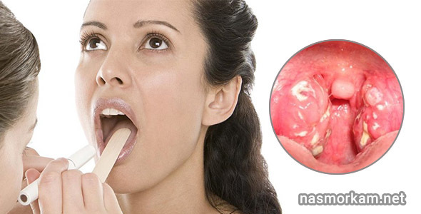Від чого виникають білі смердючі кульки в горлі?