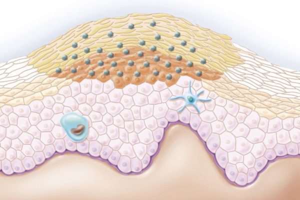 Контагіозний молюск статевому на члені: симптоми, лікування і профілактика