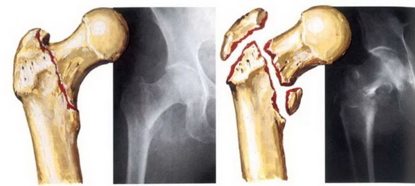 Відкритий перелом стегнової кістки зі зміщенням та без: перша допомога, терміни відновлення