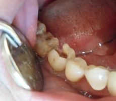 Чому випадають пломби із зубів, що робити, якщо погано поставили пломбу