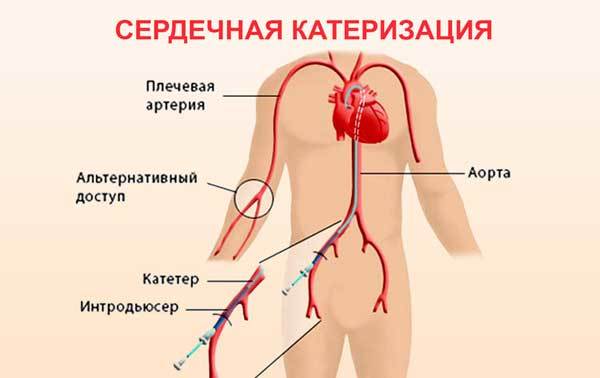 Симптоми і ознаки ішемічної хвороби серця (ішемії)