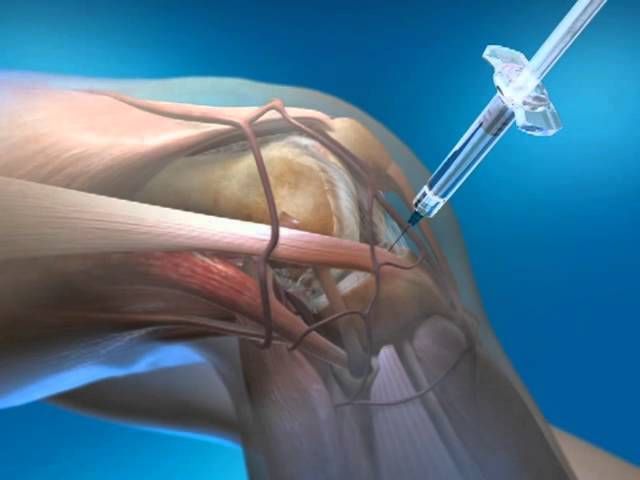 Кіста меніска колінного суглоба: симптоми, лікування в домашніх умовах, операція