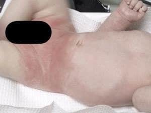 Креми і мазі під підгузник дитині, кошти для лікування пелюшкового дерматиту