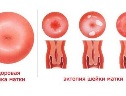 Эктопия лечение. Эктопия цилиндрического эпителия.