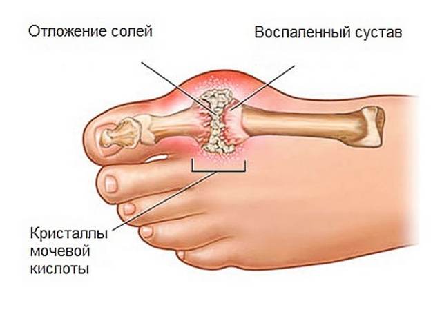 Подагра: ознаки і лікування в домашніх умовах, лікування подагри народними засобами