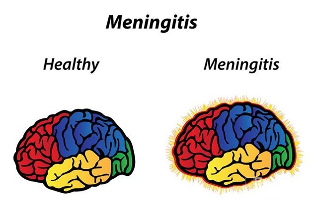 Менінгіт: симптоми, класифікація, причини виникнення, лікування та можливі ускладнення