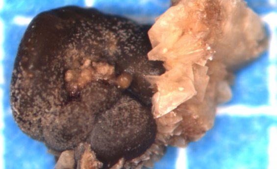 Оксалатні камені і пісок у нирках: причини утворення, як вивести камені з нирок