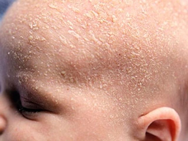 Причини лущення шкіри: що робити, якщо лущиться шкіра на обличчі, на руках, на ногах, лікування лущення шкіри у дітей