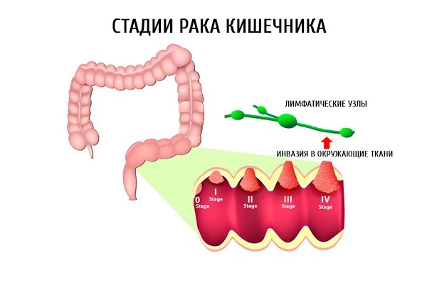 Аденокарцинома товстої кишки | ОкейДок