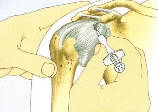 Блокада плечового суглоба: що це таке, показання, техніка виконання