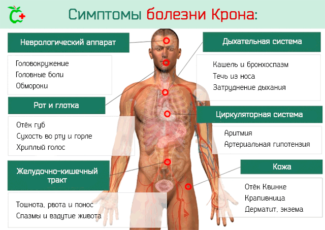 Хвороба Крона: симптоми, лікування, діагностика хвороби Крона товстої кишки і тонкого кишечника.