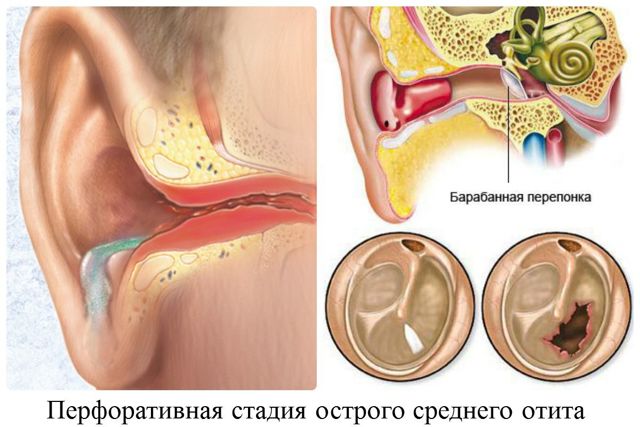 Скільки лікується ангіна (тонзиліт) у дітей і дорослих: як довго болить горло?