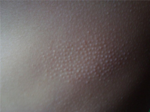 Фолікулярний гіперкератоз: лікування та причини гусячої шкіри, як позбутися неприємного явища?