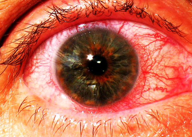 Ірит очі: симптоми і лікування, причини, як лікувати ірит у дитини