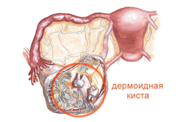 Дермоїдна кіста, тератома яєчника: симптоми, ознаки при вагітності, лікування