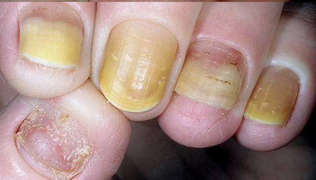 Псоріаз нігтів на руках і ногах: лікування, засоби при псоріазі нігтів