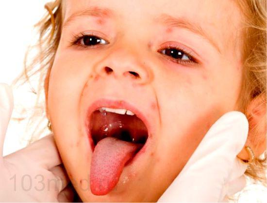 Герпесная ангіна у дітей і дорослих: симптоми і лікування