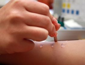 Алергопроби по крові, шкірні: різновиди тестів, показання та протипоказання, хід проведення, розшифровка результатів
