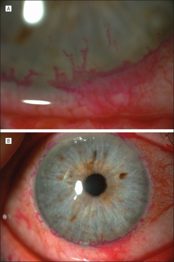 Захворювання рогівки ока: фото, опис хвороб