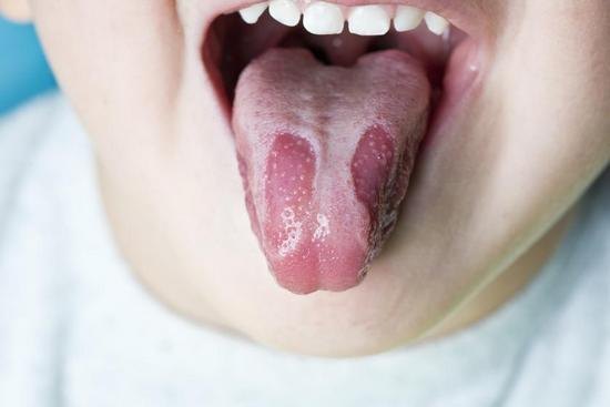 Географічний язик: причини виникнення у дорослого і дитини, лікування