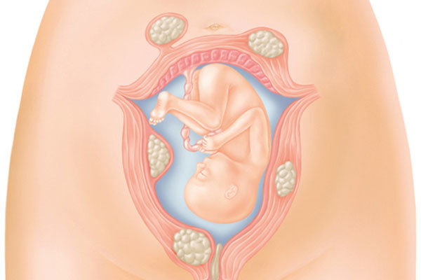 Кровотеча в другій половині вагітності: причини, методи лікування, прогноз при кровотечі на пізньому терміні вагітності