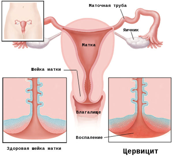 Цервіцит шийки матки: причини захворювання, його симптоми, методи лікування