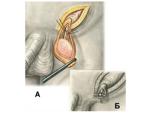 Ампутація статевого члена: показання до операції і наслідки після видалення