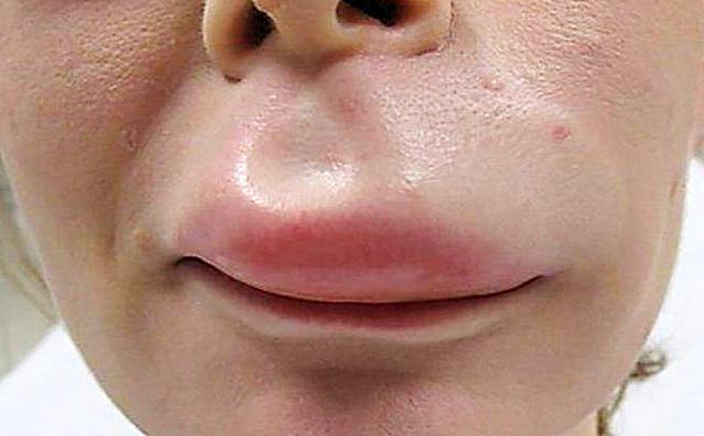 Чим лікувати алергію на обличчі якщо з'явилися червоні плями?