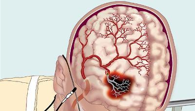 Хронічна недостатність мозкового кровообігу: симптоми і лікування