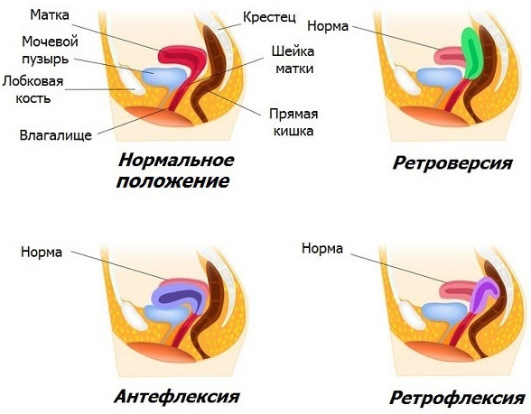 Положення матки Anteflexio: нормальне положення матки в малому тазу