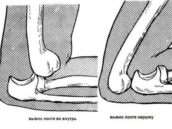 Біль в ліктьовому суглобі з внутрішньої сторони руки: причини, діагностика та лікування