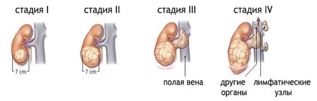 Рак нирок: перші ознаки, діагностика раку нирок, лікування, прогноз при раку нирок