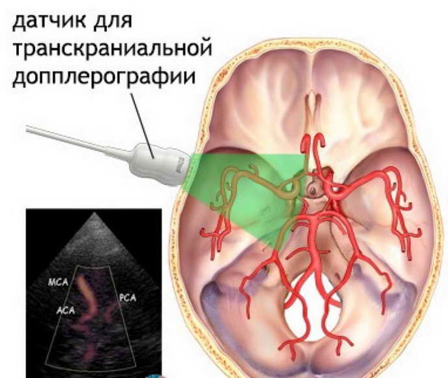 УЗД судин голови і шиї - особливості проведення УЗД судин головного мозку.