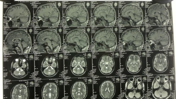 Знімок показує гіпертрофію, а МРТ без патологій, кому вірити?