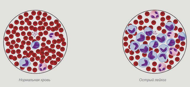 Причини лейкозу крові у дітей та дорослих: чому він виникає