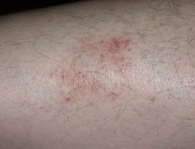 Гемосидероз шкіри ніг, тіла: опис хвороби Шамберга, діагностика, традиційні та народні методи терапії