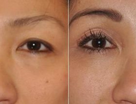 Азіатський розріз очей: операція, блефаропластика, як змінити розріз очей