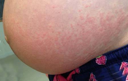 Алергія при вагітності: симптоми, вплив на плід, ніж лікувати алергію у вагітних