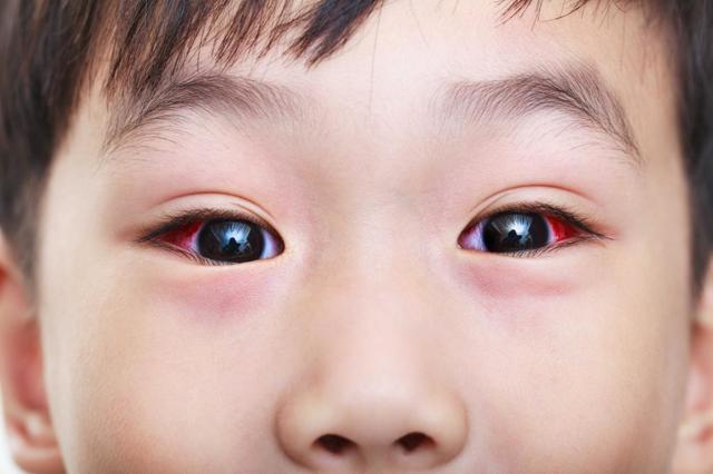 Як промивати очі чаєм (зеленим або чорним), чи можна робити це новонародженому